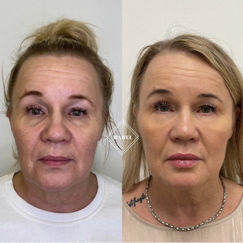 Kasvojen ja kyynelurien täyteainehoito Mabel