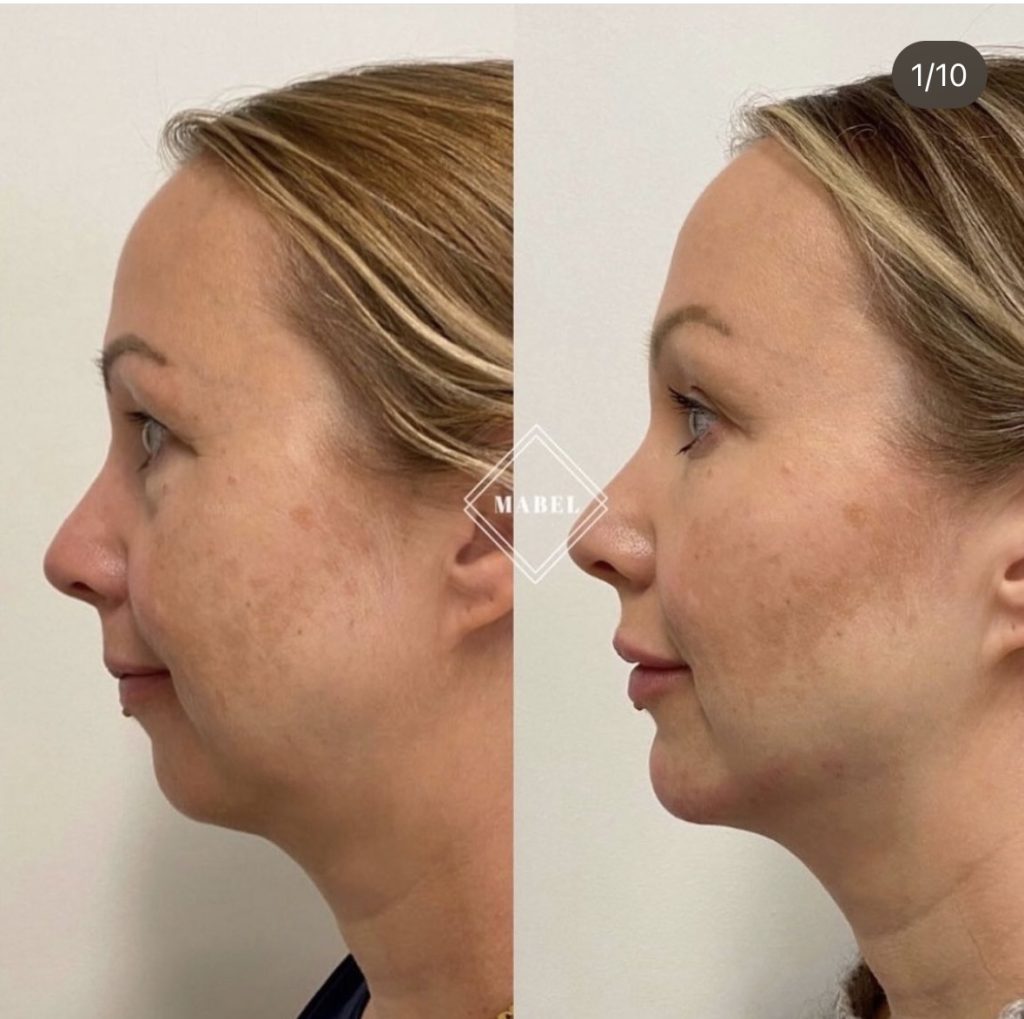 Täyteaine ja ihonhoidot