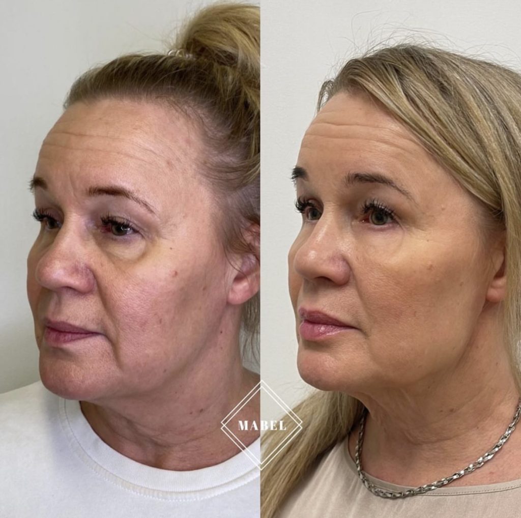 ikämuutosten hoito Kyynelurien, poskipäiden ja leukalinjan täyteainehoito