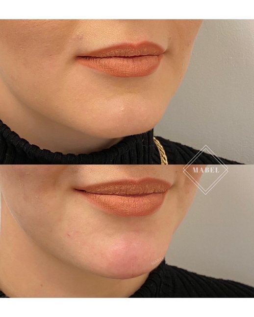 leuan kärjen symmetrian hoito täyteaineella