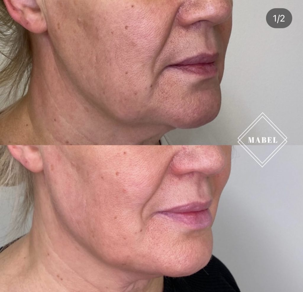 Ikämuutosten hoito täyteainehoidolla