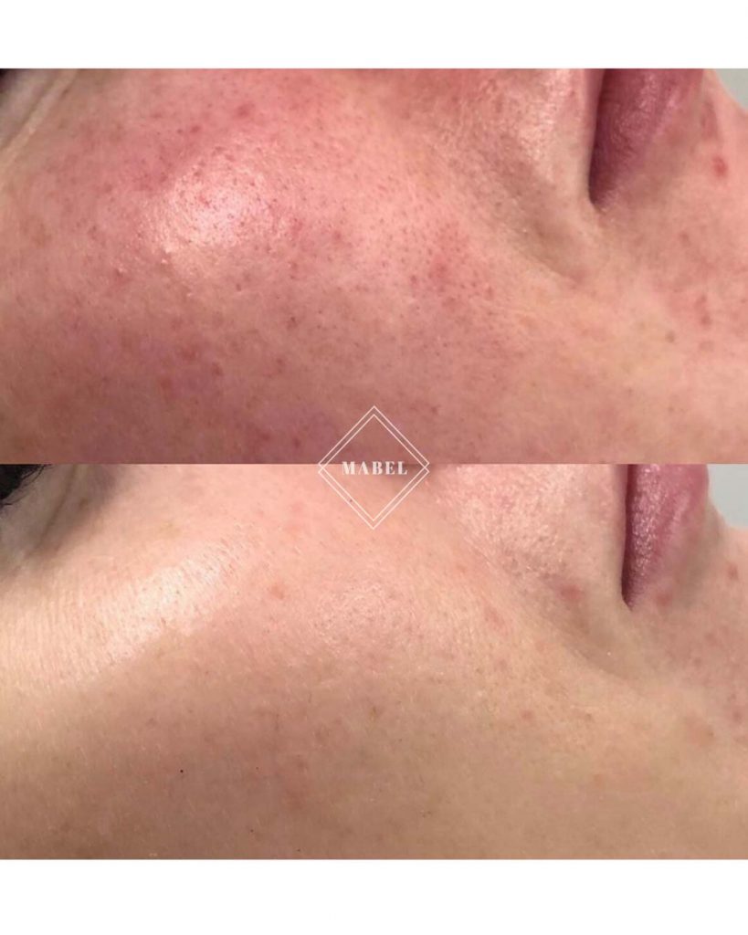 Ihon punoituksen hoito