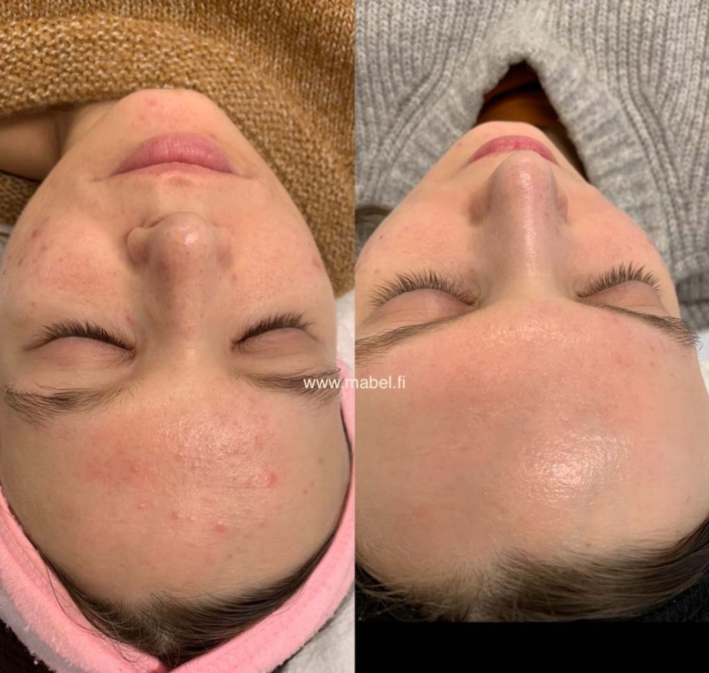 Epäpuhtaan ihon hoito