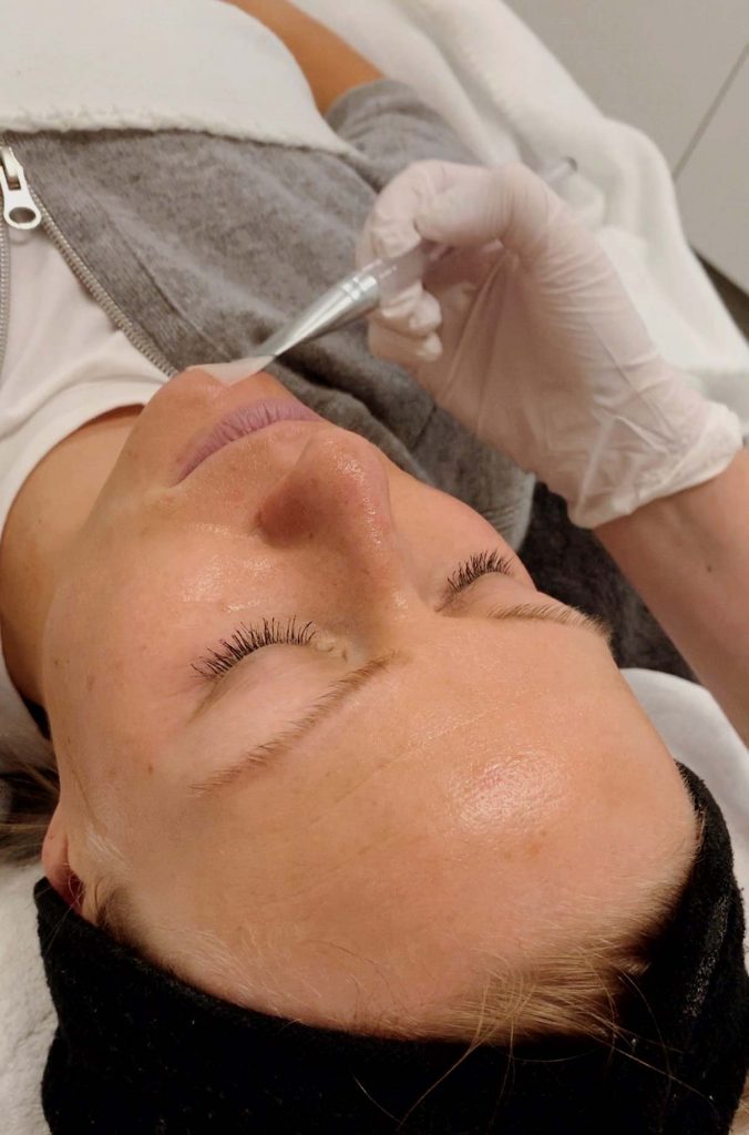 Kemiallinen kuorinta