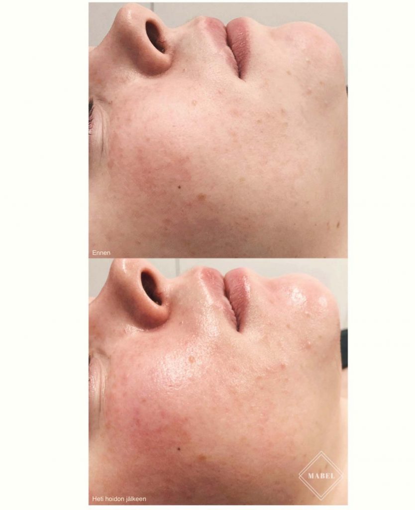 Kemiallinen kuorinta ennen jälkeen