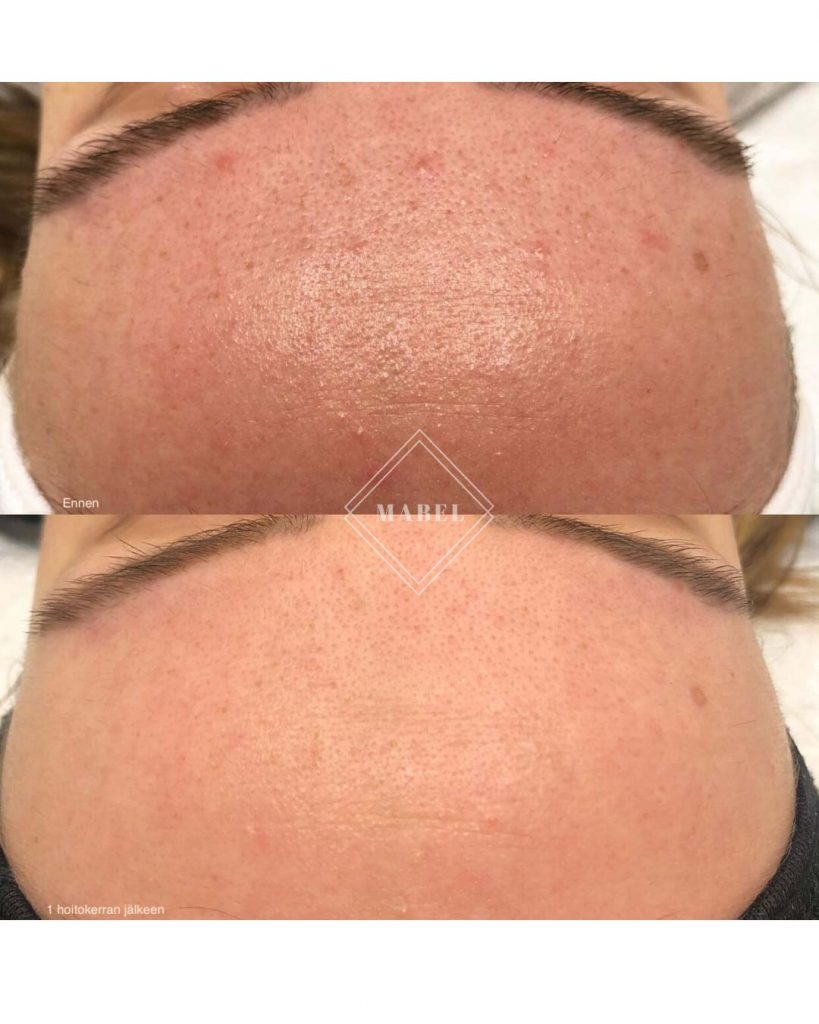 Epäpuhtaan ihon hoito