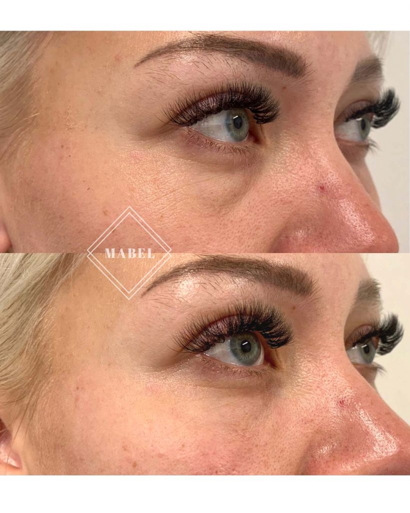 Kyynelurien täyteainehoito