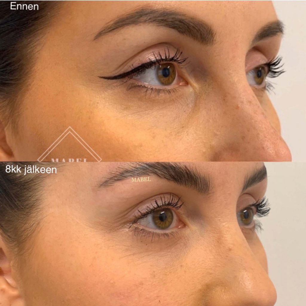 Jälkeen kuva otettu 8kk jälkeen hoidosta ja tulos on vielä hyvin nähtävissä