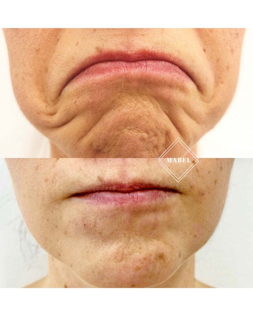 Alaspäin kääntyvien suupielten hoito