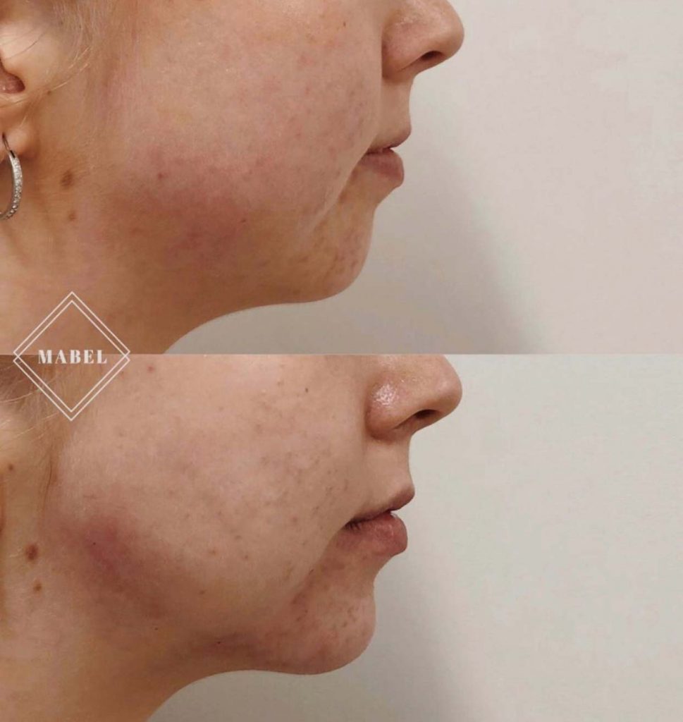 Leuan ja leukalinjan muotoilu ennen jälkeen