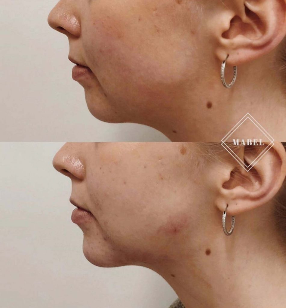 Leuan ja leukalinjan täyteainehoito