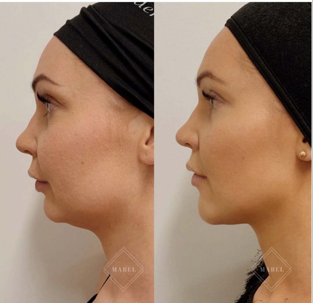 Poskien ja leukalinjan täyteainehoito