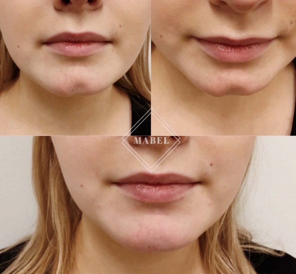 Leuan kärjen muotoilu