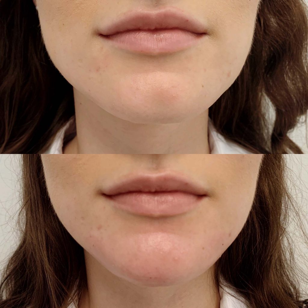 Leuan kärjen muotoilu täyteaineella