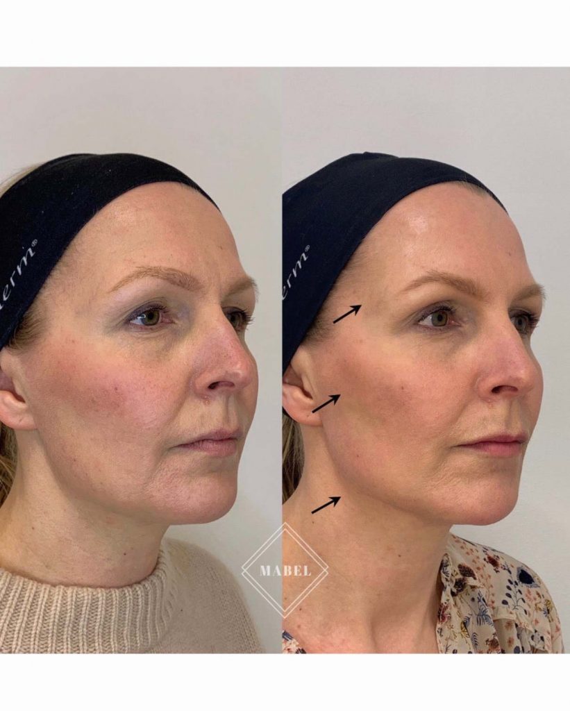 Poskipäiden kohotus ja korostus sekä leukalinjan muotoilu ennen jälkeen