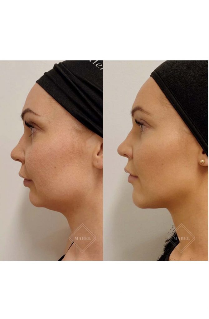 Poskipäiden kohotus ja korostus sekä leukalinjan muotoilu ennen jälkeen