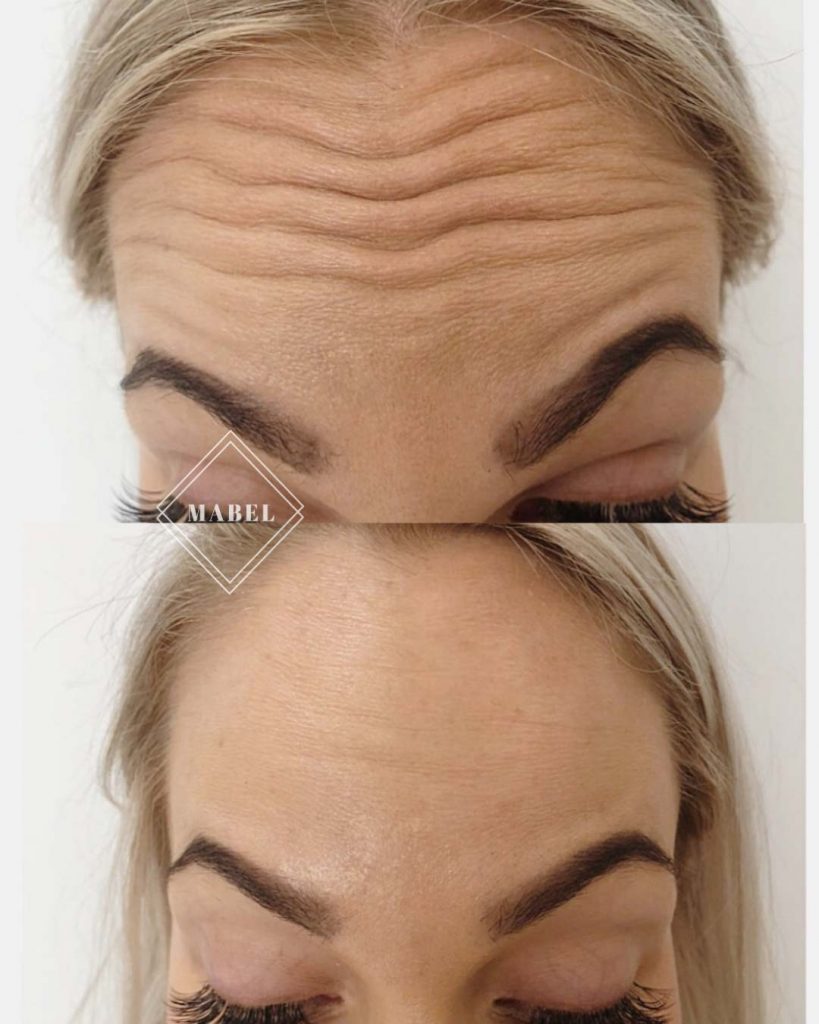 Botuliinihoidot ammattitaidolla