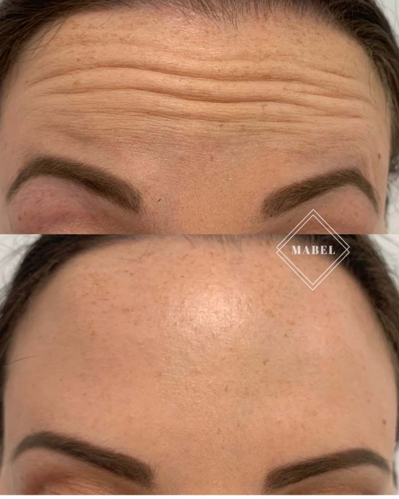 Botuliinihoidot - botoxhoidot Mabel Helsinki