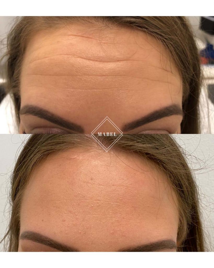 Botox hoito Helsinki