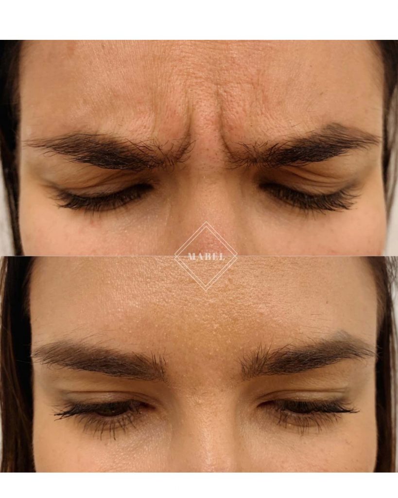 Botuliinihoito sibelius botoxhoito