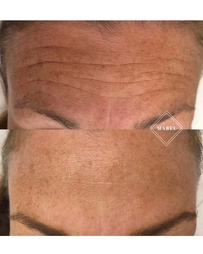 Botuliinihoito Helsinki