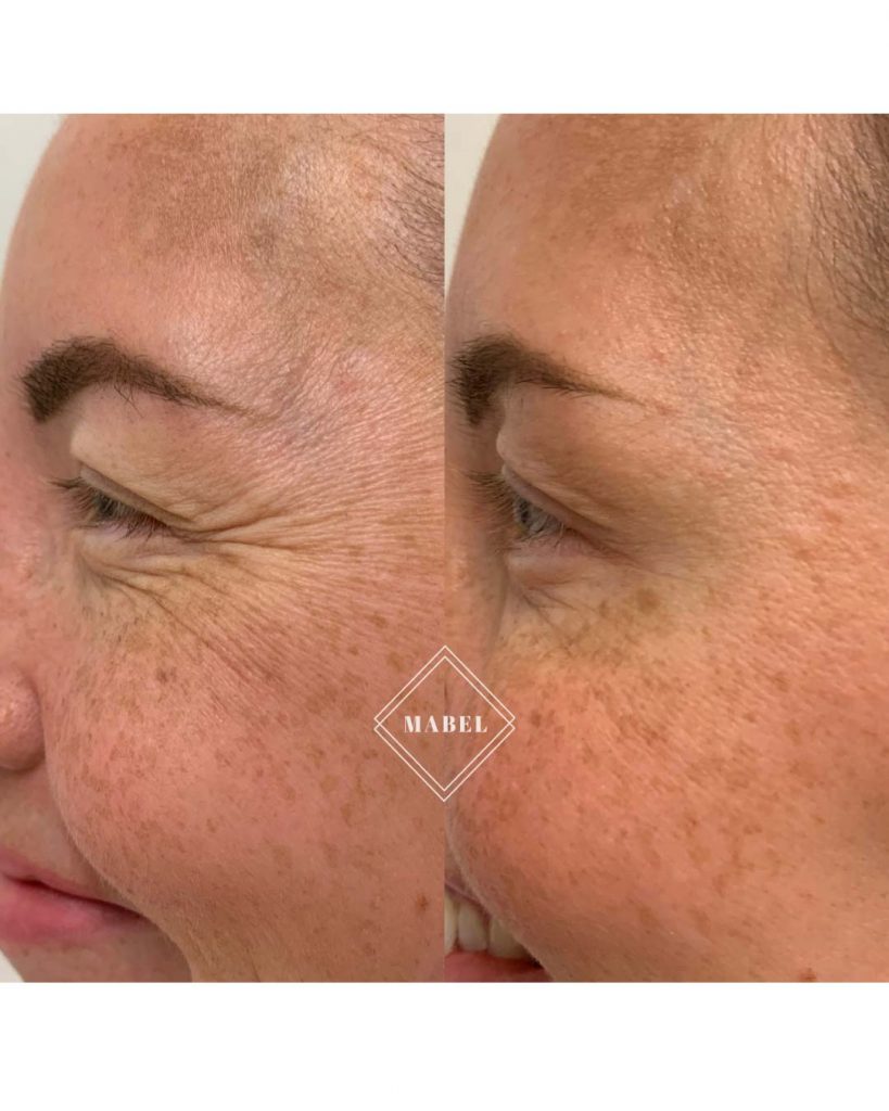 Botuliinihoito Helsinki