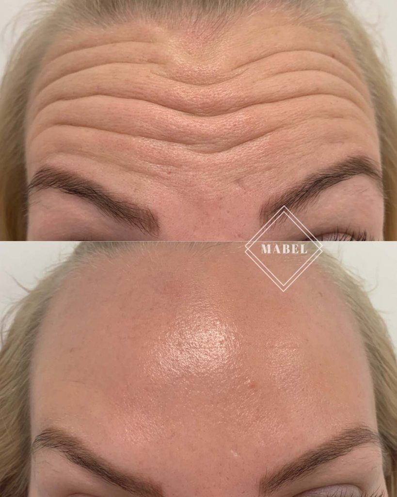 Botuliinihoito Helsinki