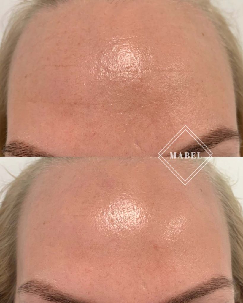 Botuliinihoito Helsinki otsa