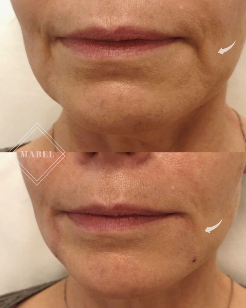 Suupielten täyteainehoito