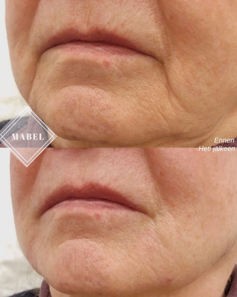 Suupielten täyteainehoito