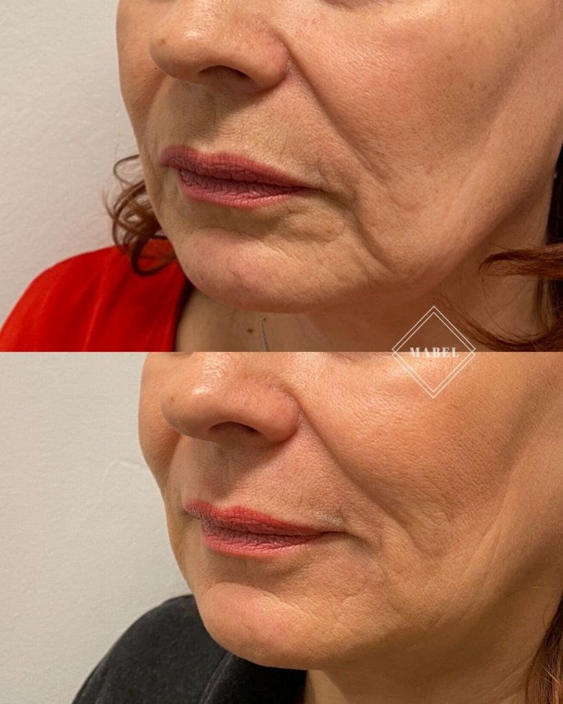 Suupielten täyteainehoito