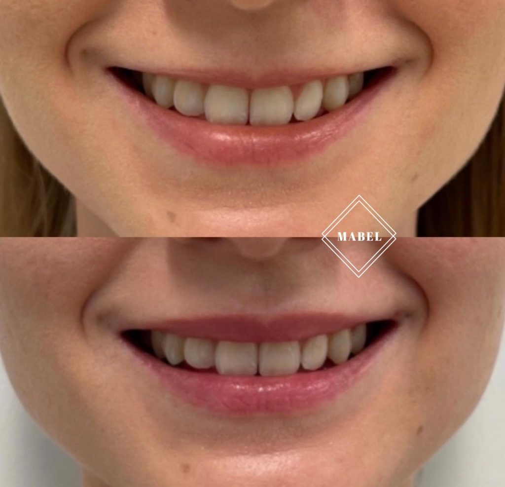 LipFlip botuliinihoidolla Mabel Helsinki