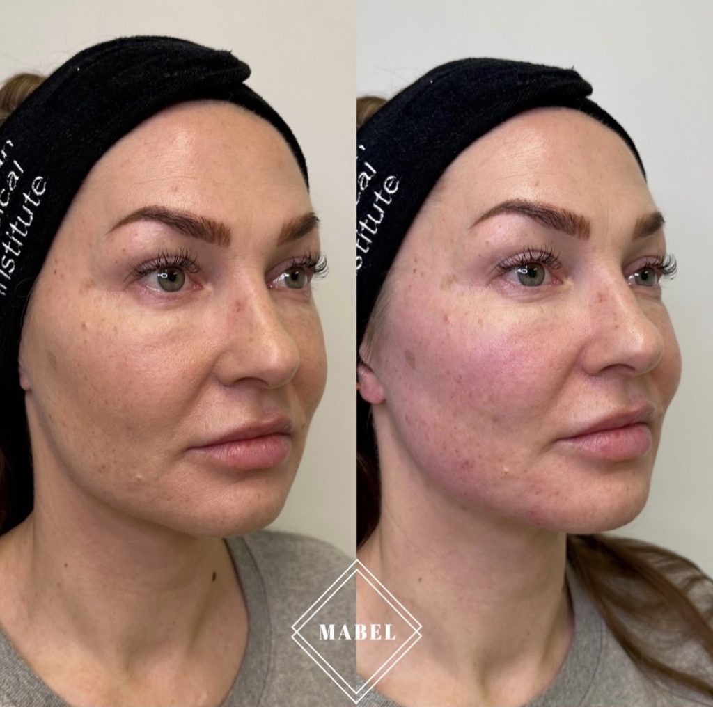 HArmonyCa hoidon tulos heti hoidon jälkeen