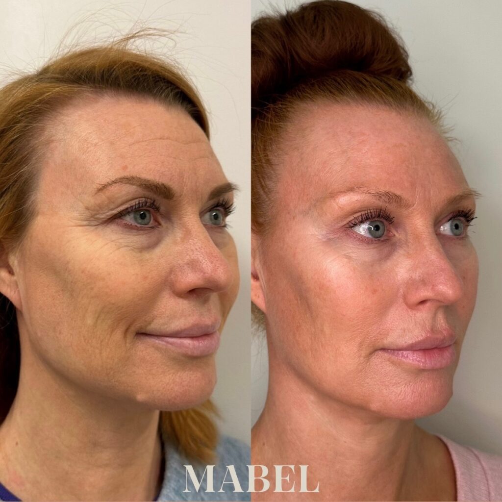 Morpheus8 radiofrekvenssihoito