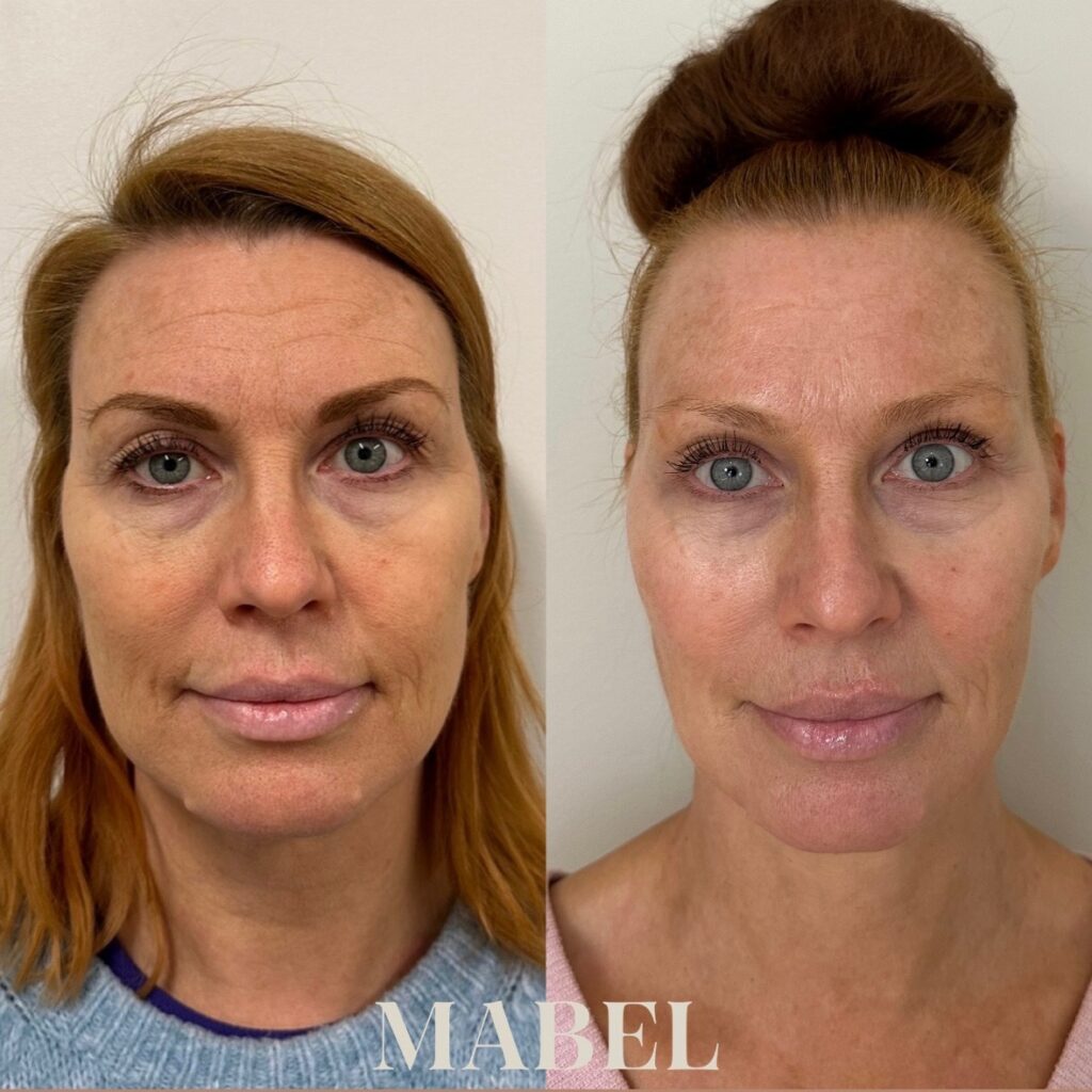 Morpheus8 radiofrekvenssihoito