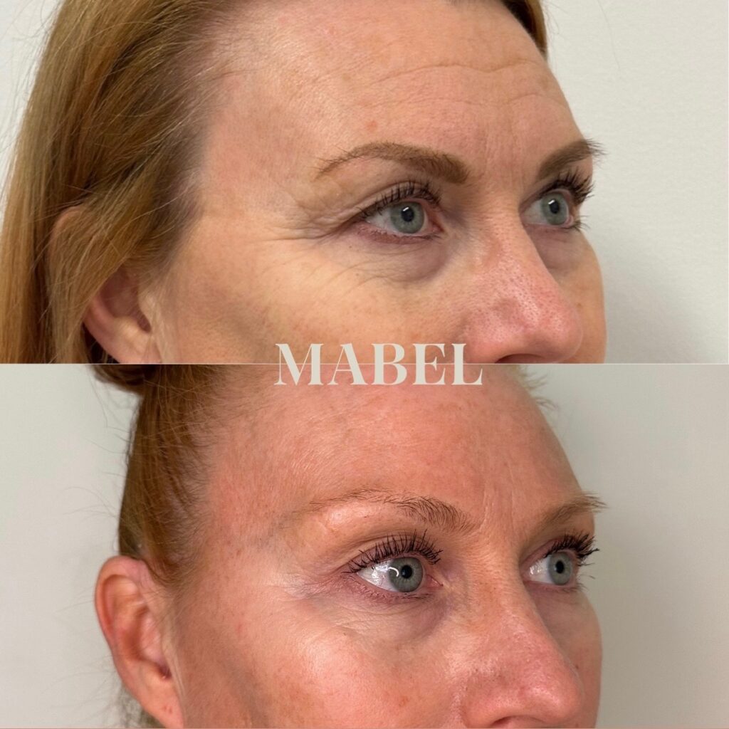 Morpheus8 radiofrekvenssihoito