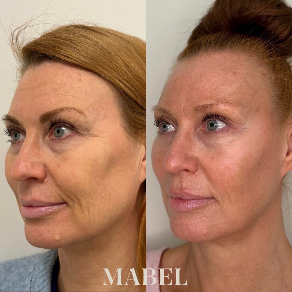 Morpheus8 radiofrekvenssihoito