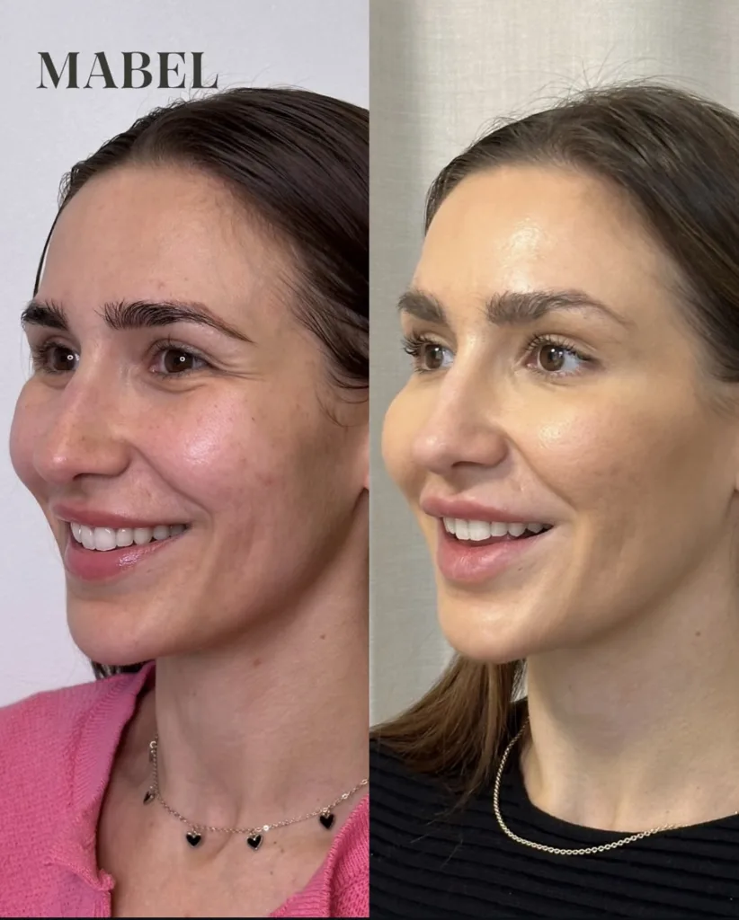 Botuliinihoito - botoxhoito Mabel helsinki ennen / jälkeen hymyrypyt