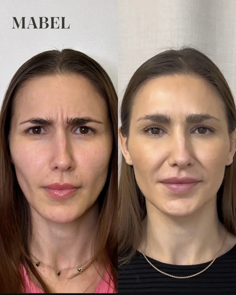 Botuliinihoito - botoxhoito Mabel helsinki ennen / jälkeen sibeius