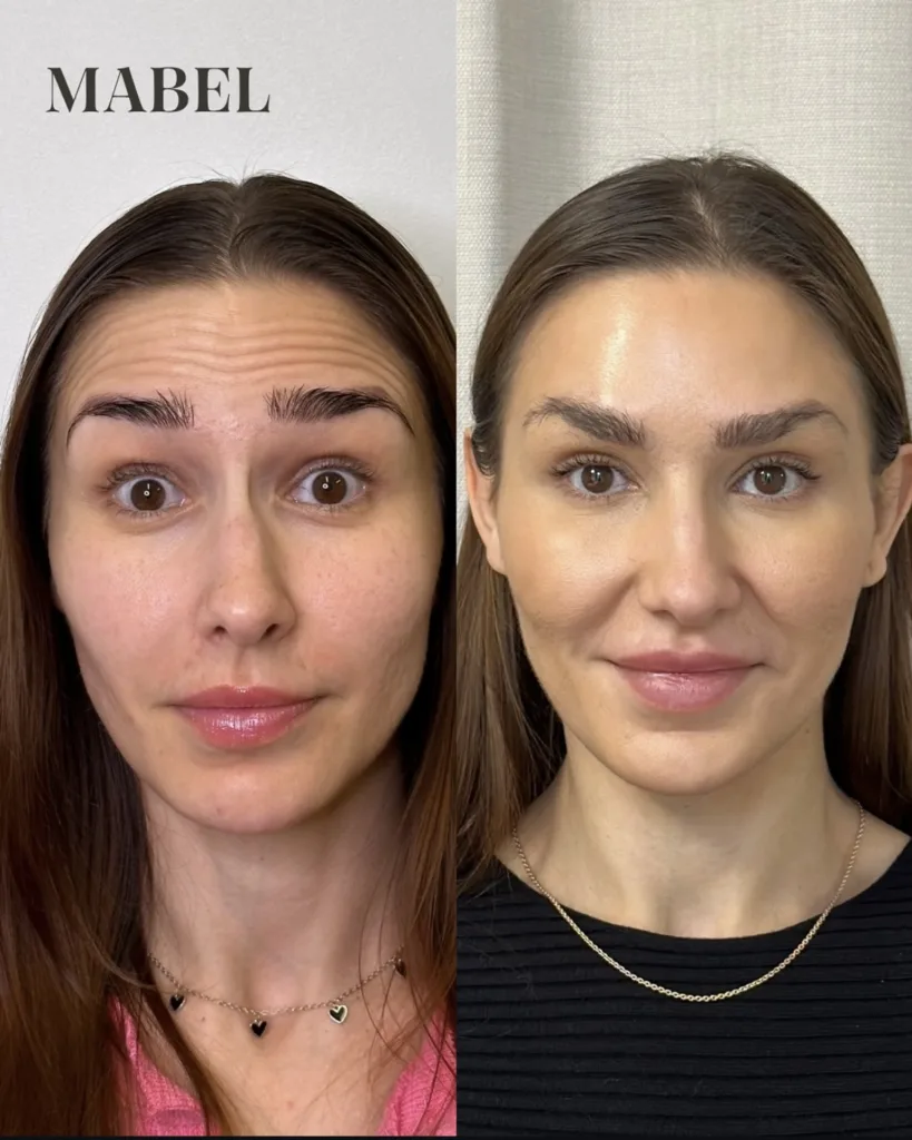 Botoxhoito - Botuliinihoito yläkasvot Mabel