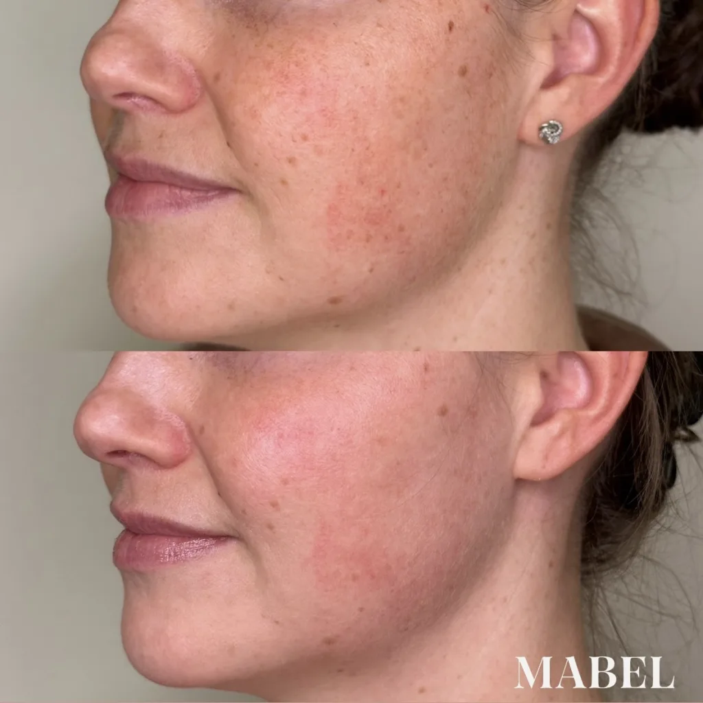 Couperosan, pisamien ja pigmenttiläikkien tasoitus