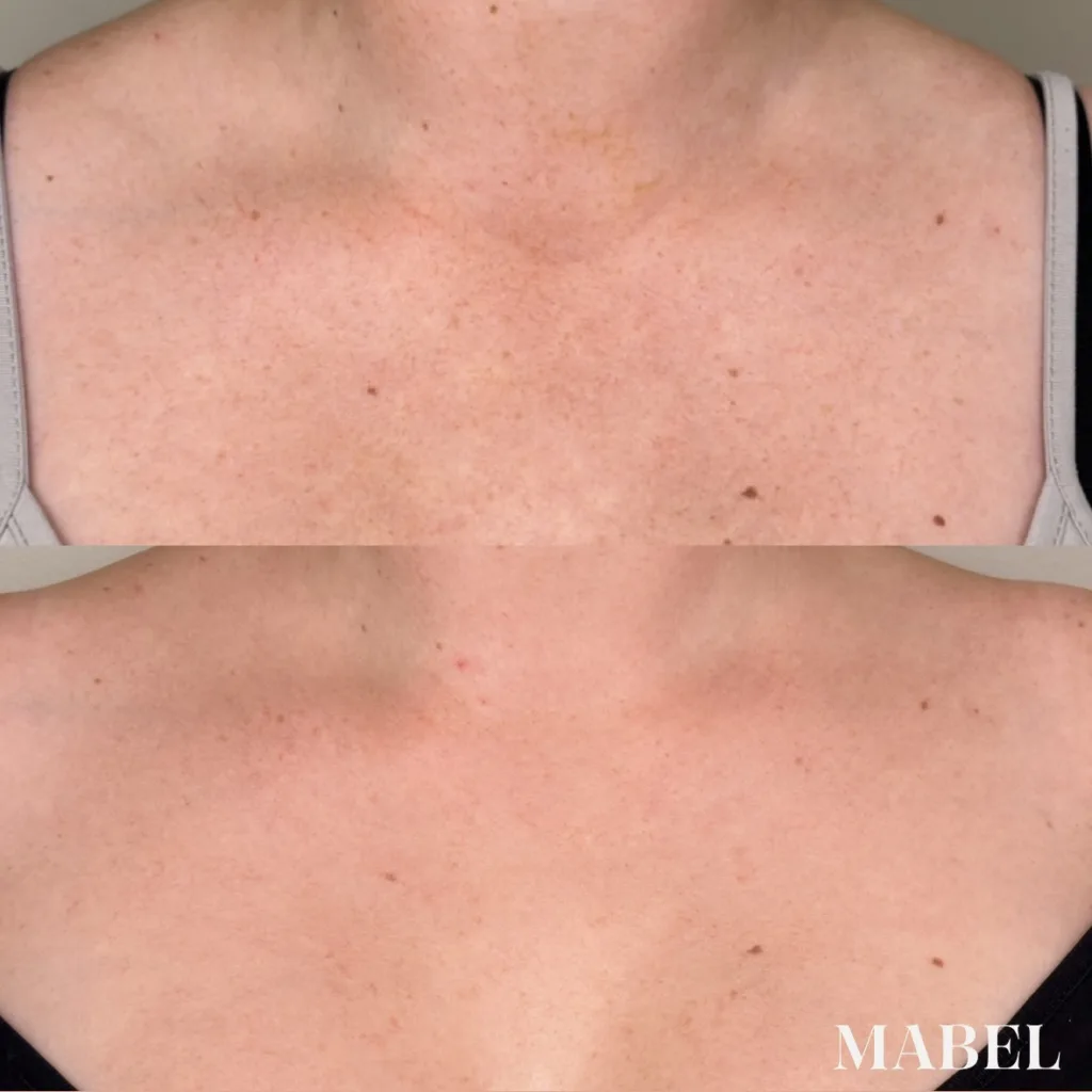 Dekolteen pigmenttiläikkien hoito Lumecca IPL