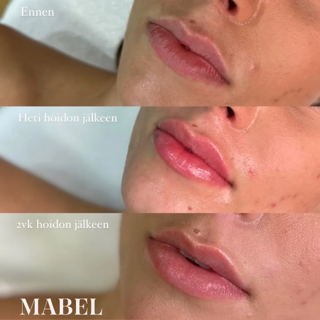 Huulten syväkosteuttava täyteainehoito Juvederm Volite.