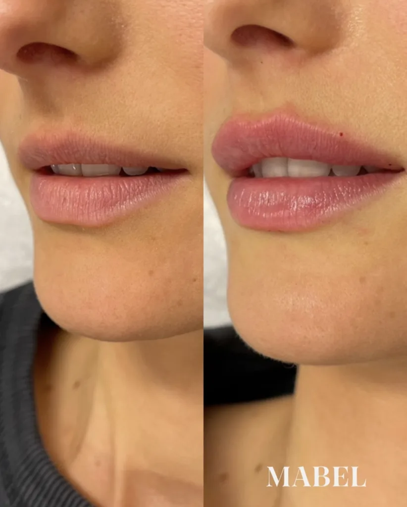 Huulten täyttö Mabel