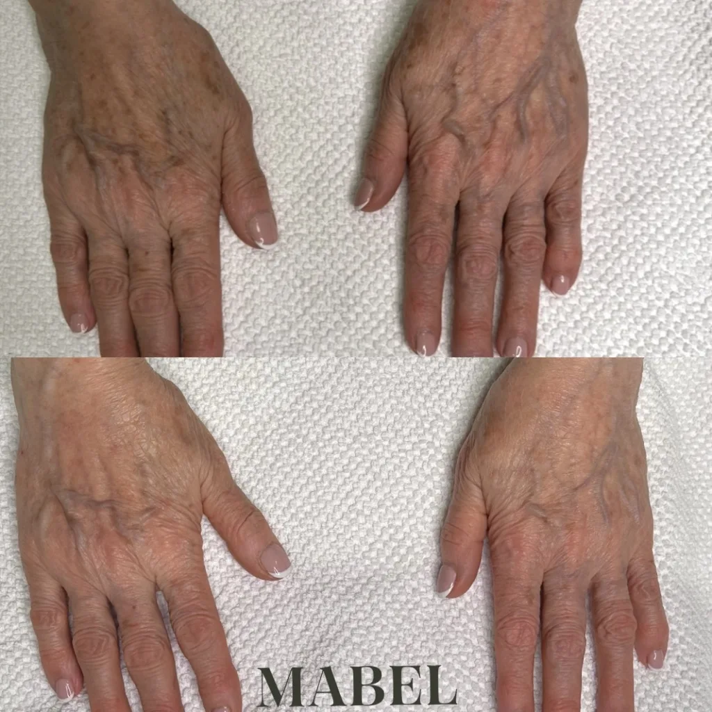 Kämmenien pigmenttimuutosten hoito Lumecca IPL