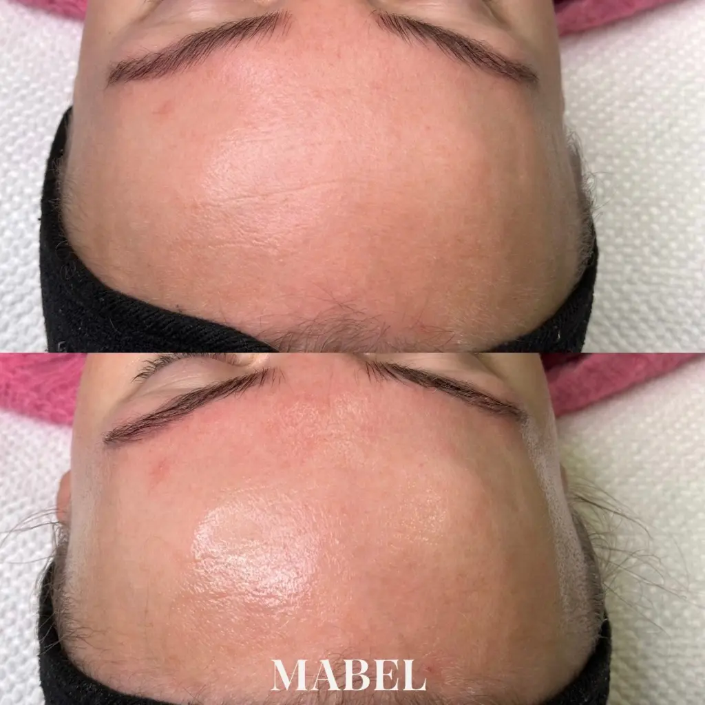 Kemiallinen kuorinta Skinbetter Science Mabel Helsinki ennen ja jälkeen