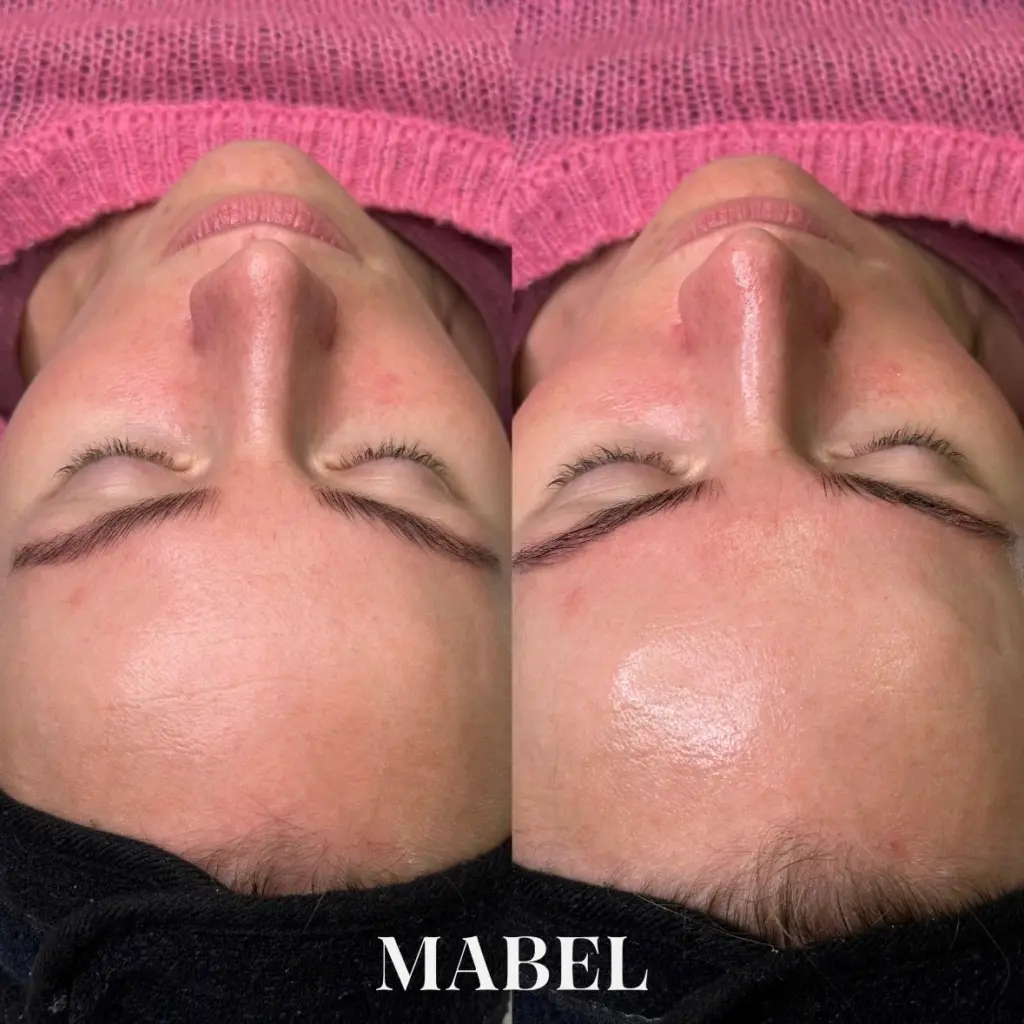 Kemiallinen kuorinta Skinbetter Science Mabel Helsinki. Kuulas, terve ja hehkuva iho