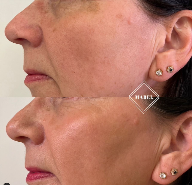 Ikämuutosten hoito Morpheus8 ja Lumecca