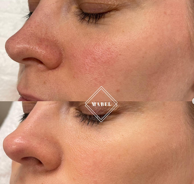 Lumecca IPL couperosan hoito