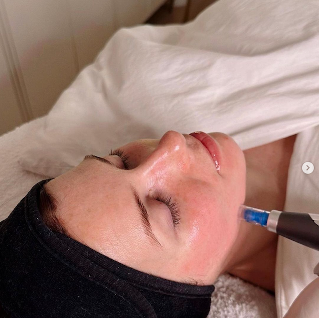 Kuivan ihon hoito mikroneulaus